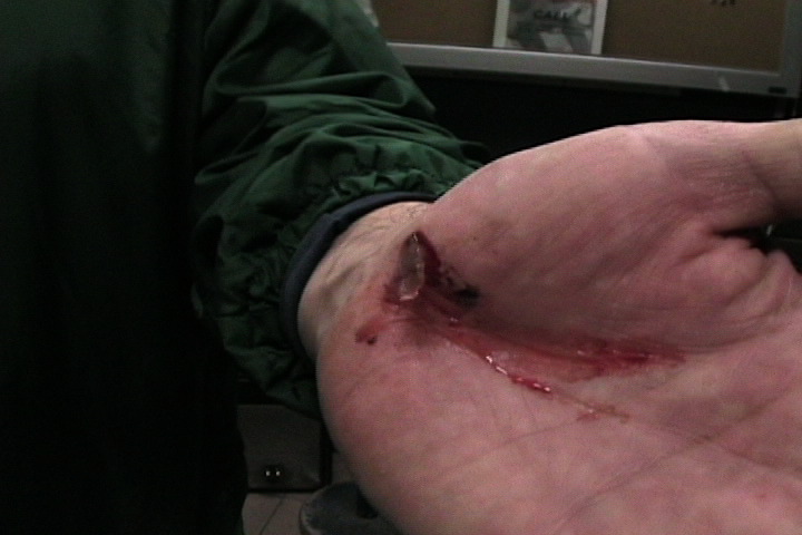 Richard Vazquez wounds from March 2007